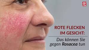 Wie beim teebaumöl solltest du aber darauf achten, die. Hautkrankheit Rosacea So Behandeln Sie Rote Flecken Im Gesicht Bildderfrau De