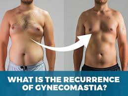 Image result for Gynecomastia