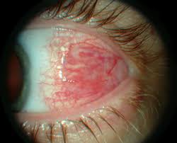 Image result for Acute Red Eye