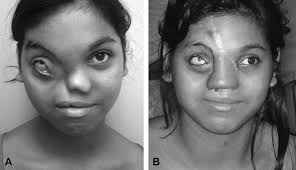 The surgical repair of half-nose