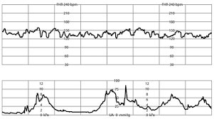 Intrapartum Fetal Monitoring American Family Physician