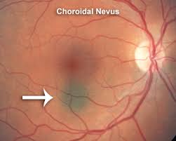 Image result for nevus sclerae