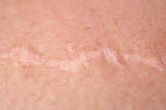 Yara Izlerini Soganla Tedavi Edebilirsiniz Sagliga Bir Adim Scar Serious Skin Care How To Cure Pimples