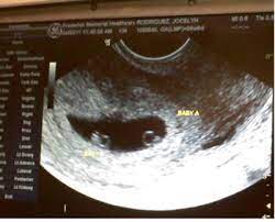 The exact time twins can be detected depends on the type of twins, for example, if they're identical (from one egg) or not. Identical 6 Weeks Pregnant Ultrasound Twins Novocom Top