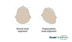Image result for Positional Head Deformity