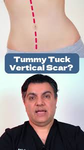 Vertical Scar After Tummy Tuck