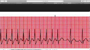 Otherwise symptoms may include palpitations, feeling lightheaded, sweating, shortness of breath, and chest pain. Health Heart Psvt
