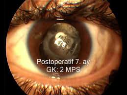 Goz Ici Yabanci Cisim Cikarilmasi Youtube