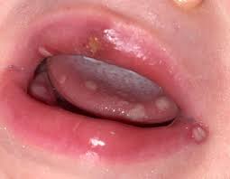 Cold Sore January 2019 Birth Club Babycenter Australia
