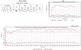 Image result for Oculovestibular Testing