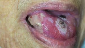Image result for white cancer on tongue)