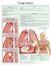 Download Pdf Lung Cancer E Chart Full Illustrated Popular