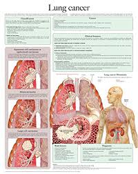 download pdf lung cancer e chart full illustrated popular