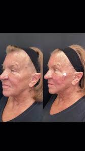 Introducing PDO Threads at 4EverYoung Fleming Island!, Ready to lift,  tighten, and glow — without surgery?, PDO (Polydioxanone) threads are  dissolvable sutures placed under the skin to instantly lift ...