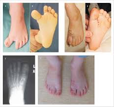 Image result for Hallux Varus