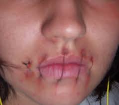 These stitches will dissolve and don't need to be removed. Sewn Mouth How To Make A Stitch How To By Ami