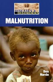 Amazon.co.jp: Malnutrition (Diseases and Disorders) : Nardo, Don: Foreign  Language Books