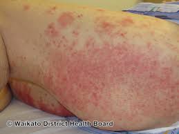 Image result for itchy skin rectum