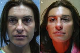 Adipose Tissue: From Energy Reservoir to a Source of Cells for Epithelial  Tissue Engineering