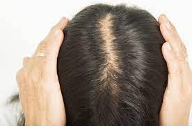 Can hair loss from pcos be reversed? Causes And Treatments Of Pcos Hair Loss How To Reverse It