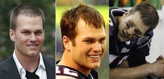 Tom Brady Hair Transplant Myth And Facts Men S Hairstyles Club Help Hair Loss Hair Loss Cure Hair Loss Remedies