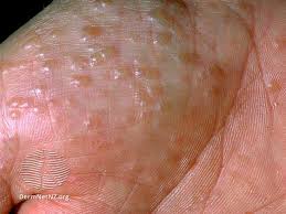 Image result for dyshidrosis