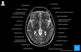 Brain Mri Anatomy Anatomy Drawing Diagram