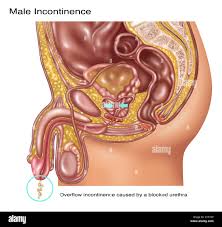 Image result for Overflow Incontinence