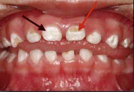 White Spot Lesions On Primary Baby Teeth