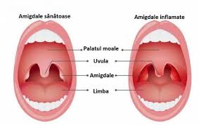 • pete albe sau puroi pe amigdale sau gat; Cand Ne Operam De Amigdalele Palatine Alerta Orl
