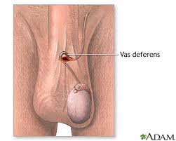 Image result for Vasectomy