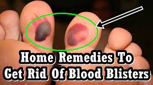 Where in the mouth exactly? How To Get Rid Of Blood Blister Yeyelife