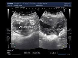 Early Pregnancy | Sonoguide