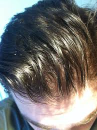 Avodart dutasteride has been shown to decrease levels of the hair loss causing hormone, dihydrotestosterone dht by 90% after only two weeks, making it a potentially. Six Years On Oral Dutasteride Diffuse Balder Maintaining From Baseline Baldtruthtalk Com