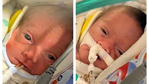 Fundraiser for Ashley Pauline by Megan Dever : The Pauline Twins Journey to  Life