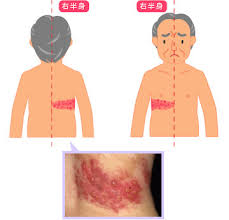 Definition of 帯状疱疹, meaning of 帯状疱疹 in japanese: å¸¯çŠ¶ç–±ç–¹ ã‹ã—ã®ãçš®è†šç§'