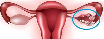 Maybe you would like to learn more about one of these? What Is An Ovarian Dermoid And Why Does It Grow Teeth Mamadoctorjones