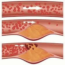 Tegn og symptomer som antyder at en person har gått i hjertestans inkluderer Hjerteinfarkt Store Medisinske Leksikon