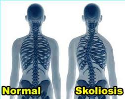 We did not find results for: Bahaya Dan Fakta Menarik Skoliosis Yang Jarang Orang Ketahui