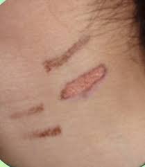 A burn after laser hair removal may be red, blistering, swollen, and in the shape of the tip of the laser applicator device. Laser Hair Removal Can Cause First Degree Burns Health Gulf News