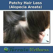 In one study of 25 patients diagnosed with hypothyroidism , researchers found hair symptoms were present in 68% of patients. Thyroid Hair Loss