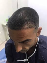 pin na doske hair transplant in istanbul