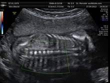 Anomaly Scan Wikipedia