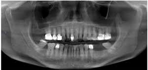 Maybe you would like to learn more about one of these? A Short Case Study Is It Periapical Cemental Dysplasia Dentistry Today