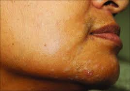 Image result for Postinflammatory Hypopigmentation
