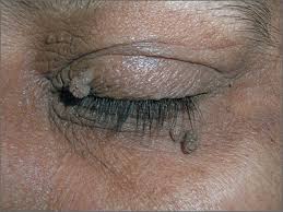 See full list on mayoclinic.org Growths On Eyelids Mdedge Family Medicine