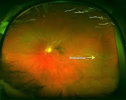 A retinal detachment occurs when the retina separates from its attachments to the tissues within the eye. Floaters Retinal Tears And Retinal Detachments Visionaware