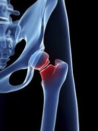 Hip pain is a rare indicator of bone cancer, but take note of any swelling or severe ache that makes it hard to move. Three Types Of Hip Fractures Treatments Rebound Orthopedics Neurosurgery Vancouver Portland