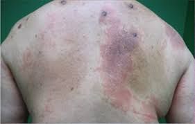 Image result for Pemphigoid