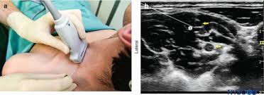 Image result for Superior Trunk Block